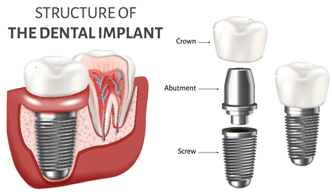 Dental Implants | Fort St. John Dental Clinic, BC